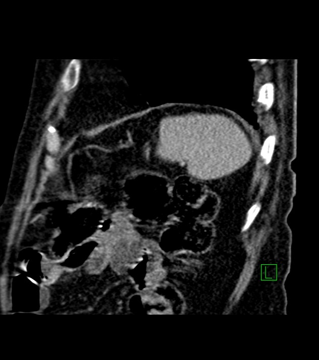 Cholangiocarcinoma with cerebral metastases (Radiopaedia 83519-98629 Sagittal C+ delayed 20).jpg