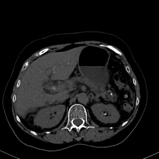 File:Cholecystitis - obstructive choledocholitiasis (CT intravenous cholangiography) (Radiopaedia 43966-47479 Axial 83).png
