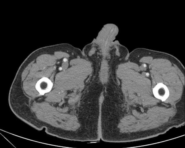 Cholecystitis - perforated gallbladder (Radiopaedia 57038-63916 A 91).jpg