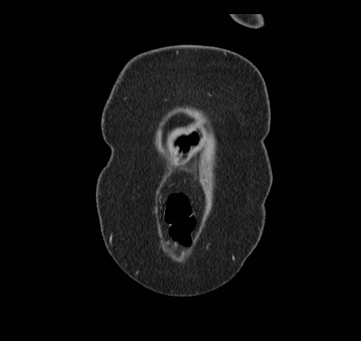 Cholecystoduodenal fistula (Radiopaedia 48959-54022 B 7).jpg