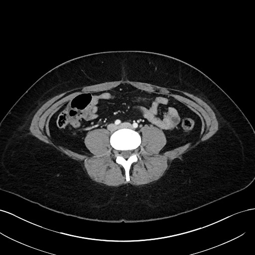 File:Choledocholithiasis after recent cholecystectomy (Radiopaedia 60929-68737 Axial 8).jpg