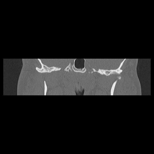 Cholesteatoma (Radiopaedia 84946-100455 Coronal bone window 79).jpg