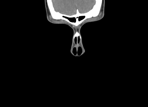 Chondroblastic osteosarcoma (Radiopaedia 67363-76741 D 1).jpg