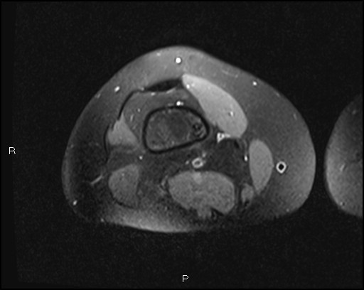 File:Chondroblastoma (Radiopaedia 62721-71031 Axial PD fat sat 5).jpg