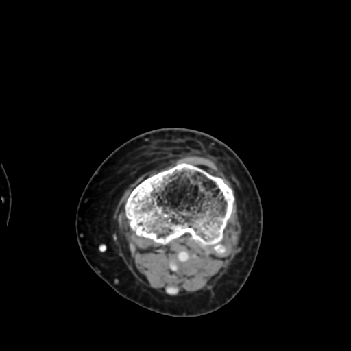 File:Chondrosarcoma - femur (Radiopaedia 64187-72954 Axial with contrast 67).jpg