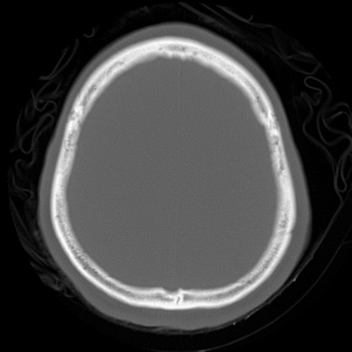 File:Chondrosarcoma - sphenoid wing (Radiopaedia 58259-67828 Axial bone window 22).jpg