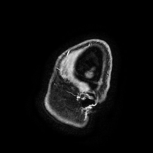 Chordoid glioma of third ventricle (Radiopaedia 91612-109340 F 195).jpg