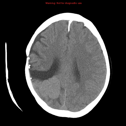 File:Choroid plexus carcinoma - recurrent (Radiopaedia 8330-9168 Axial non-contrast 18).jpg