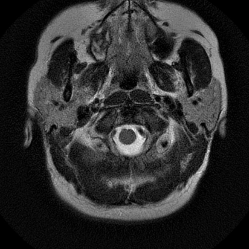 File:Choroid plexus xanthogranuloma (Radiopaedia 17650-17386 T2 24).jpg