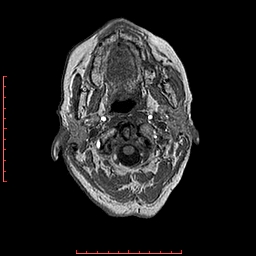 File:Choroid plexus xanthogranuloma (Radiopaedia 67843-77270 Axial T1 157).jpg