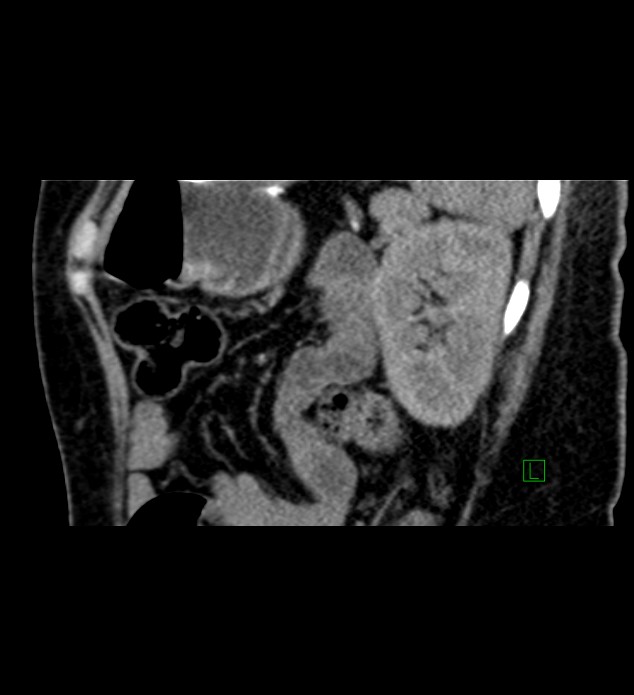 Chromophobe renal cell carcinoma (Radiopaedia 84290-99582 D 24).jpg