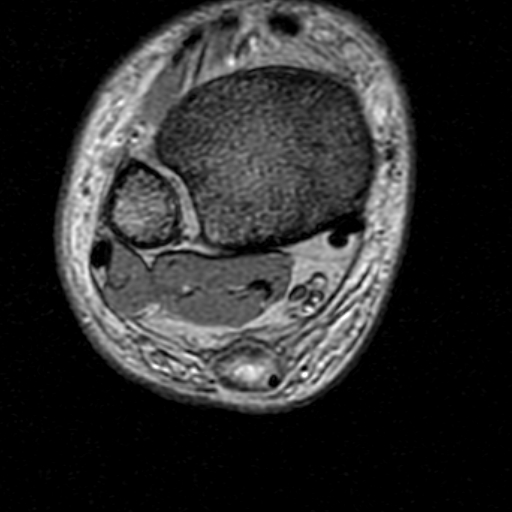 File:Chronic Achilles tendon rupture (Radiopaedia 15262-15100 Axial Gradient Echo 7).jpg
