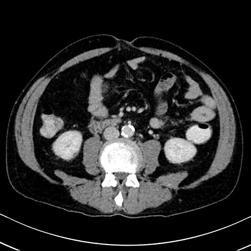 Chronic appendicitis complicated by appendicular abscess, pylephlebitis and liver abscess (Radiopaedia 54483-60700 B 84).jpg