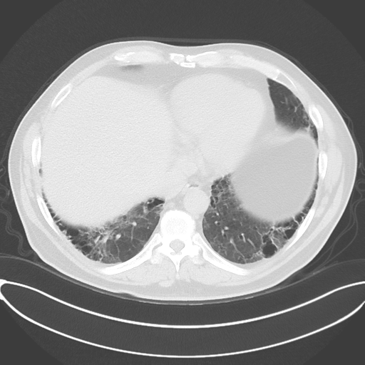 File:Chronic hypersensitivity pneumonitis (Radiopaedia 48107-52922 Axial lung window 46).png