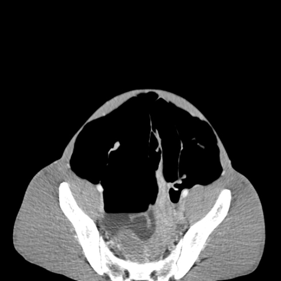 Chronic large bowel pseudo-obstruction (Radiopaedia 43181-46492 A 139).jpg