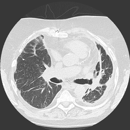 Chronic lung allograft dysfunction - restrictive form (Radiopaedia 60595-68316 Axial lung window 32).jpg