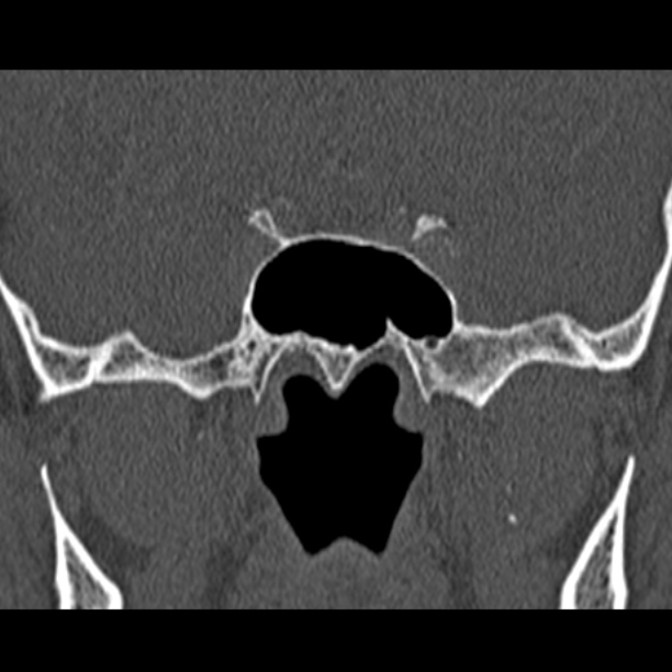 Chronic maxillary sinusitis (Radiopaedia 27879-28116 Coronal bone window 47).jpg