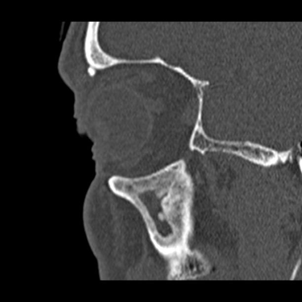 Chronic maxillary sinusitis (Radiopaedia 27879-28116 Sagittal bone window 48).jpg