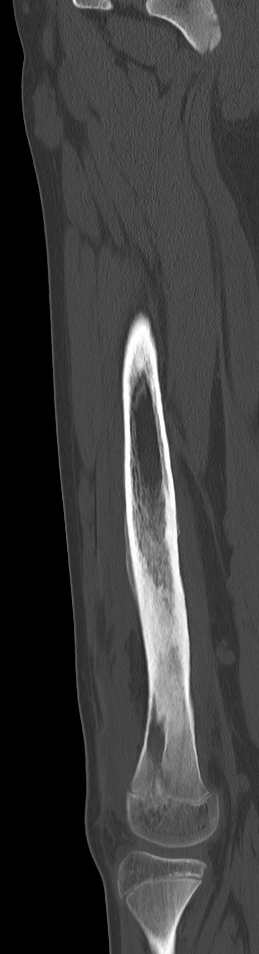 Chronic ostemyelitis of the femur with long sinus tract (Radiopaedia 74947-85982 Sagittal bone window 47).jpg