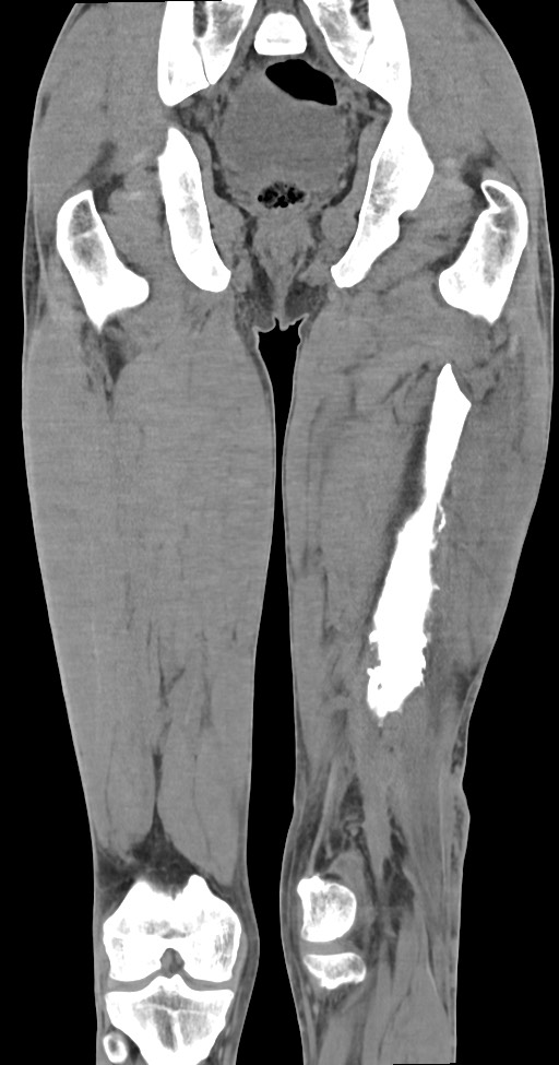 Chronic osteomyelitis (with sequestrum) (Radiopaedia 74813-85822 E 36).jpg