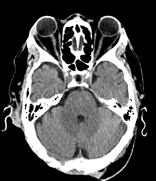 File:Chronic osteomyelitis - calvarial (severe) (Radiopaedia 69668-79616 Axial non-contrast 36).jpg