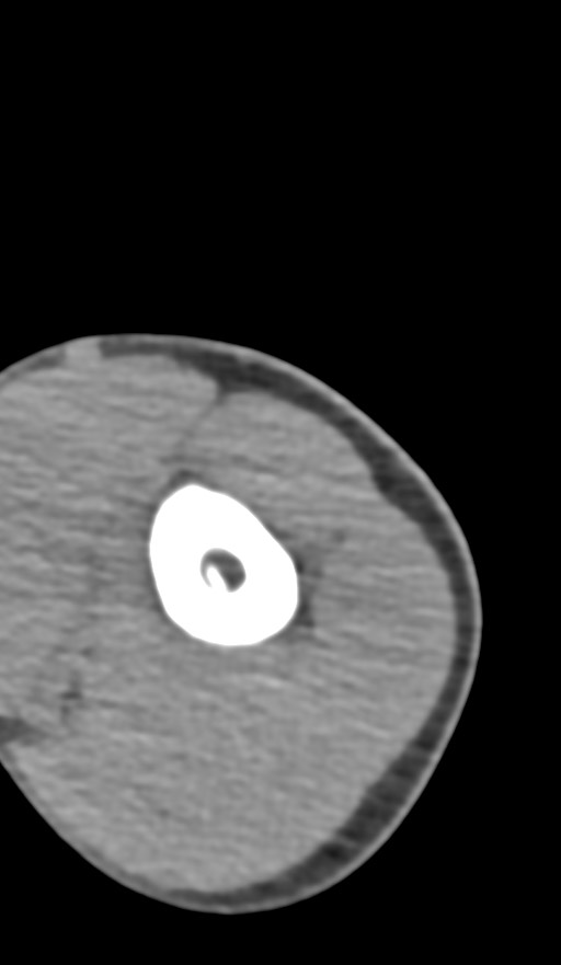 Chronic osteomyelitis of the distal humerus (Radiopaedia 78351-90971 Axial non-contrast 34).jpg