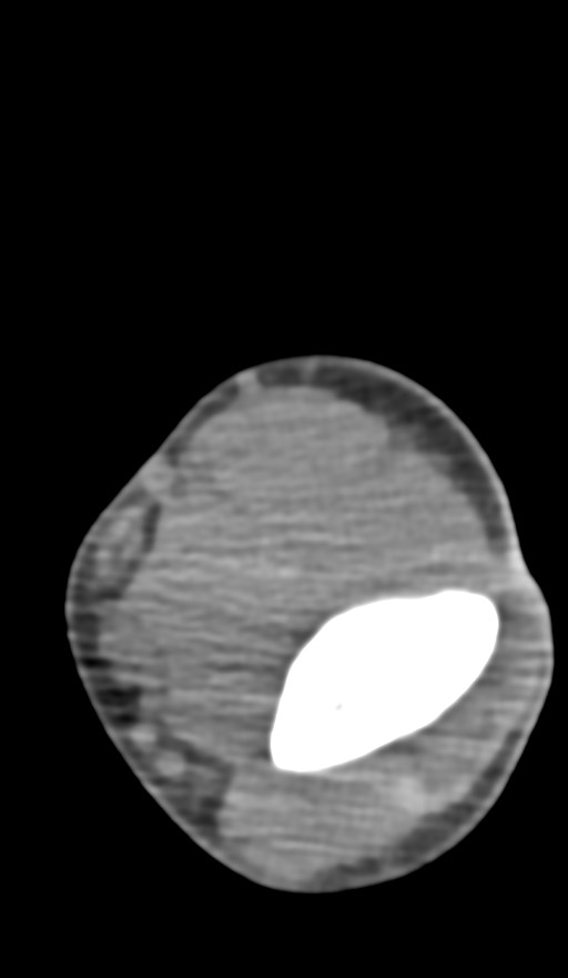 Chronic osteomyelitis of the distal humerus (Radiopaedia 78351-90971 Axial non-contrast 79).jpg