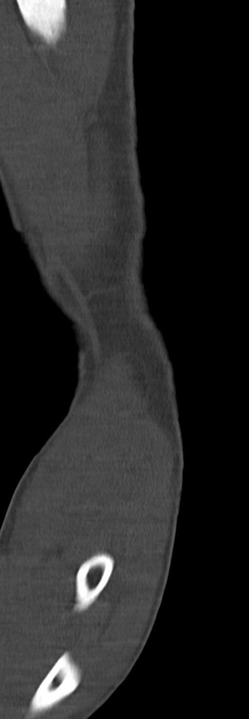 Chronic osteomyelitis of the distal humerus (Radiopaedia 78351-90971 Sagittal bone window 31).jpg