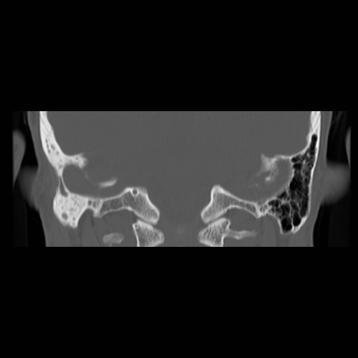 File:Chronic otomastoiditis (Radiopaedia 27138-27309 Coronal bone window 17).jpg