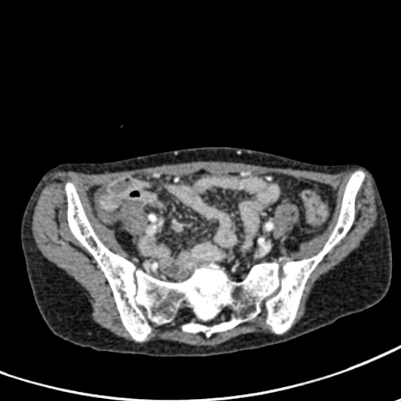 Chronic pancreatitis (Radiopaedia 55405-61846 A 81).jpg