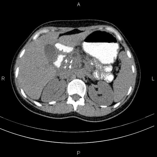Chronic pancreatitis (Radiopaedia 64576-73450 Axial non-contrast 43).jpg