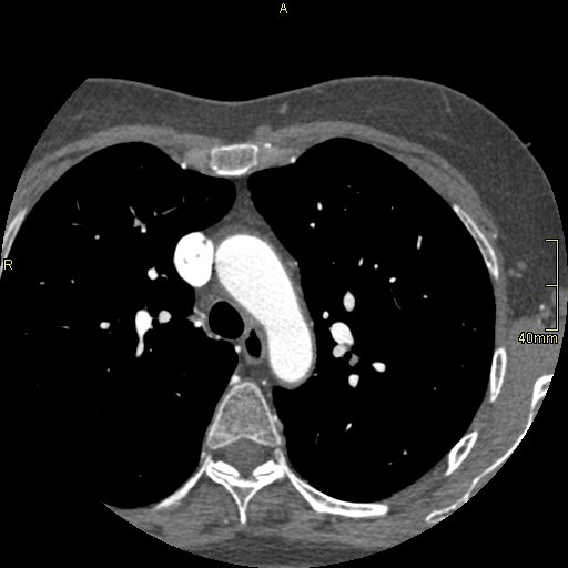 Chronic pulmonary embolism (Radiopaedia 73073-85094 Axial C+ CTPA 28).jpg
