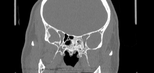 Chronic sphenoidal sinusitis (Radiopaedia 62030-70122 Coronal bone window 104).jpg