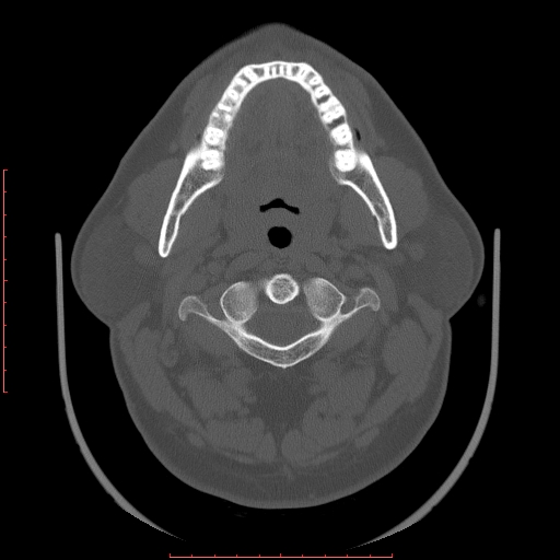 File:Chronic submandibular sialolithiasis (Radiopaedia 69817-79814 Axial bone window 40).jpg