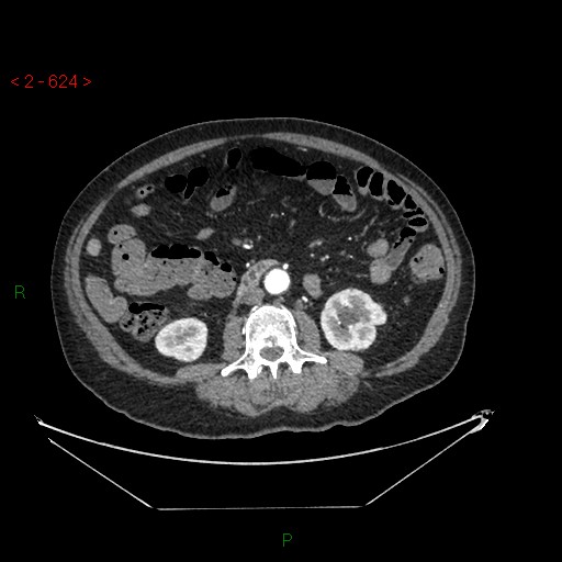 File:Circumaortic left renal vein and doubled left renal arteries (Radiopaedia 52268-58158 A 160).jpg