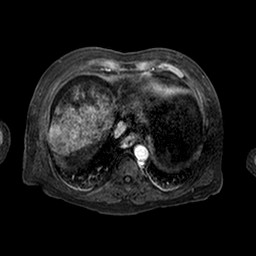 Cirrhosis and hepatocellular carcinoma in the setting of hemochromatosis (Radiopaedia 75394-86594 Axial T1 C+ fat sat 155).jpg