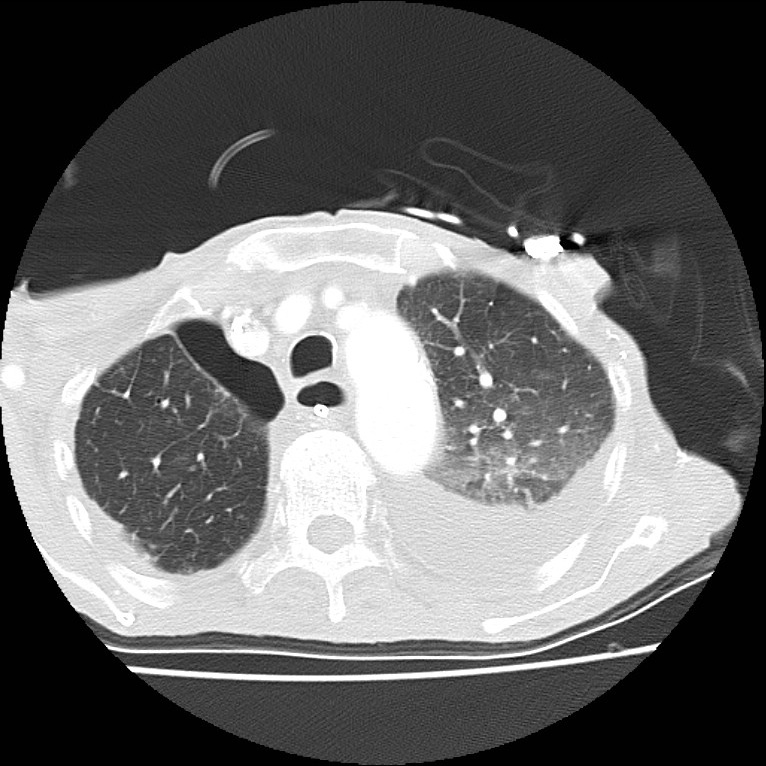 Clagett thoracotomy with bronchopleural fistula (Radiopaedia 29192-29587 Axial lung window 12).jpg