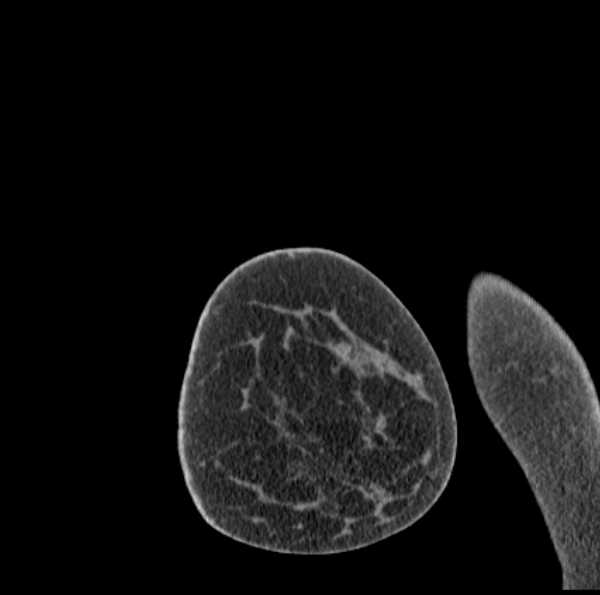 File:Clear cell chondrosarcoma - humerus (Radiopaedia 63104-71612 D 1).jpg
