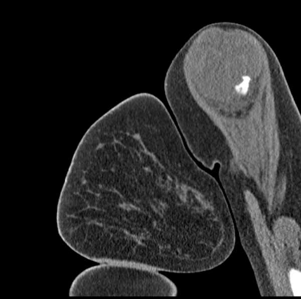 Clear cell chondrosarcoma - humerus (Radiopaedia 63104-71612 D 11).jpg