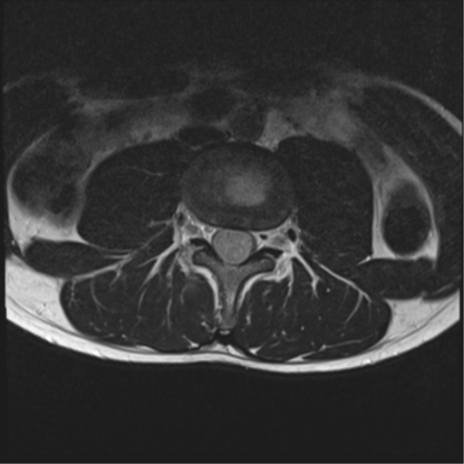 File:Clear cell meningoma - lumbar spine (Radiopaedia 60116-67690 Axial T2 20).png