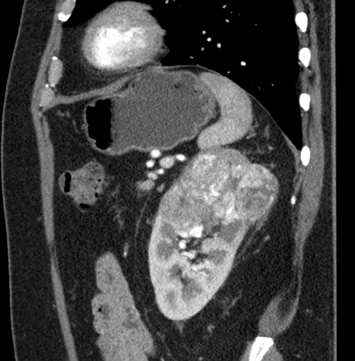 File:Clear cell renal cell carcinoma (Radiopaedia 61449-69393 D 21).jpg