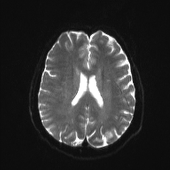 File:Clival meningioma (Radiopaedia 53278-59248 Axial DWI 16).jpg