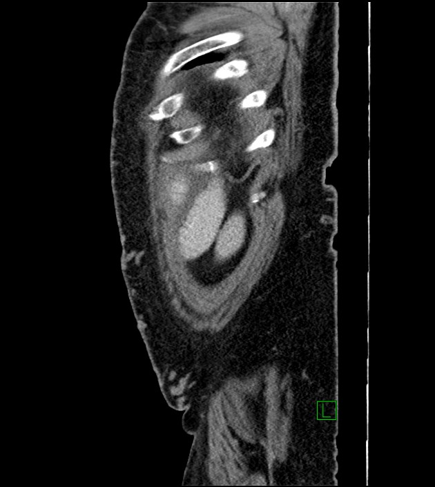 Closed-loop small bowel obstruction-internal hernia (Radiopaedia 78439-91096 C 20).jpg
