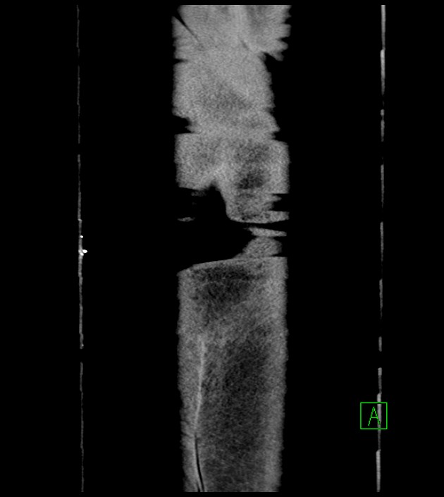 Closed-loop small bowel obstruction-internal hernia (Radiopaedia 78439-91096 Coronal non-contrast 108).jpg