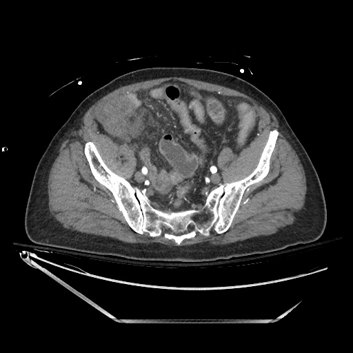 File:Closed loop obstruction due to adhesive band, resulting in small bowel ischemia and resection (Radiopaedia 83835-99023 B 121).jpg