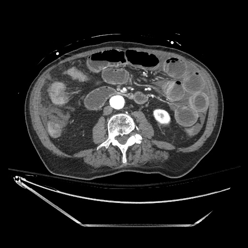 Closed loop obstruction due to adhesive band, resulting in small bowel ischemia and resection (Radiopaedia 83835-99023 B 78).jpg