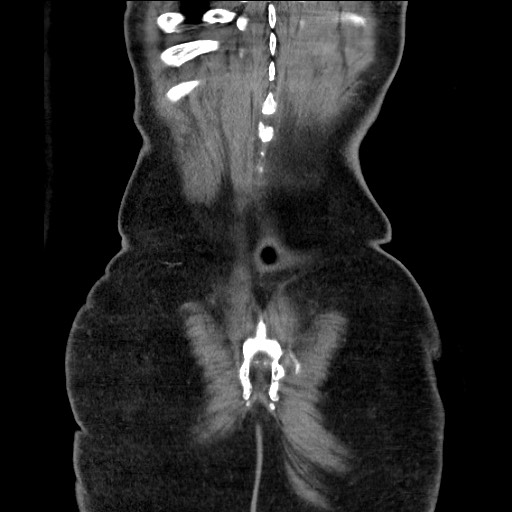 Closed loop obstruction due to adhesive band, resulting in small bowel ischemia and resection (Radiopaedia 83835-99023 E 118).jpg