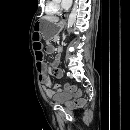 Closed loop obstruction due to adhesive band, resulting in small bowel ischemia and resection (Radiopaedia 83835-99023 F 108).jpg