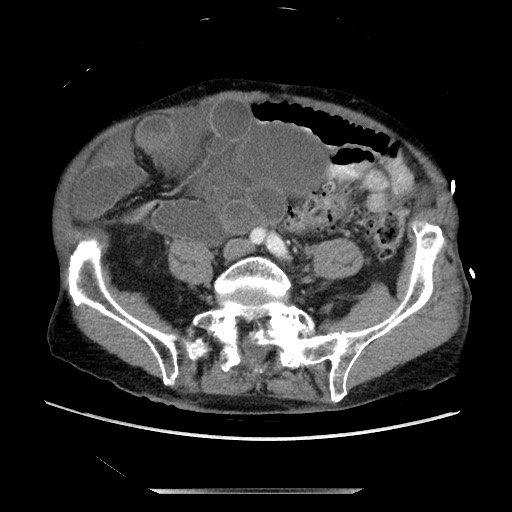 Closed loop small bowel obstruction - adhesive disease and hemorrhagic ischemia (Radiopaedia 86831-102990 A 127).jpg