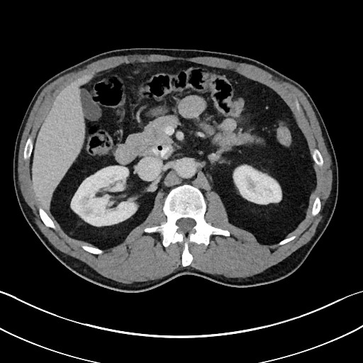 Closed loop small bowel obstruction - internal hernia (Radiopaedia 57806-64778 B 44).jpg